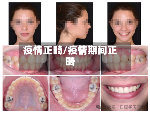 疫情正畸/疫情期间正畸