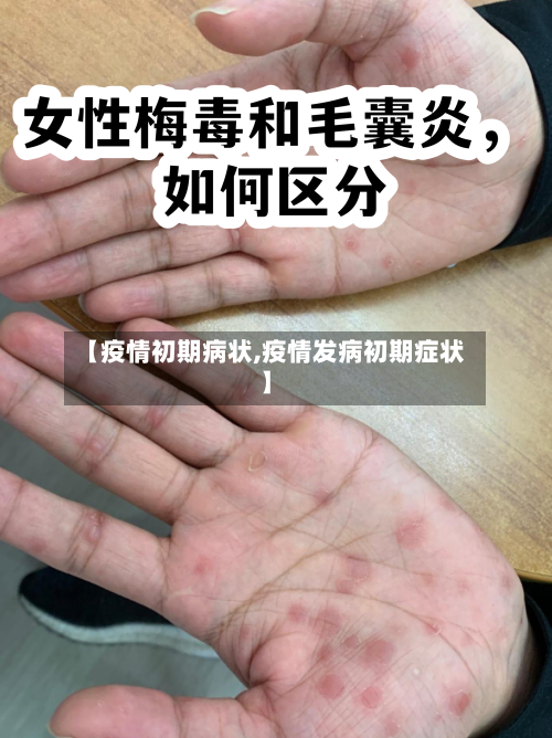 【疫情初期病状,疫情发病初期症状】-第2张图片
