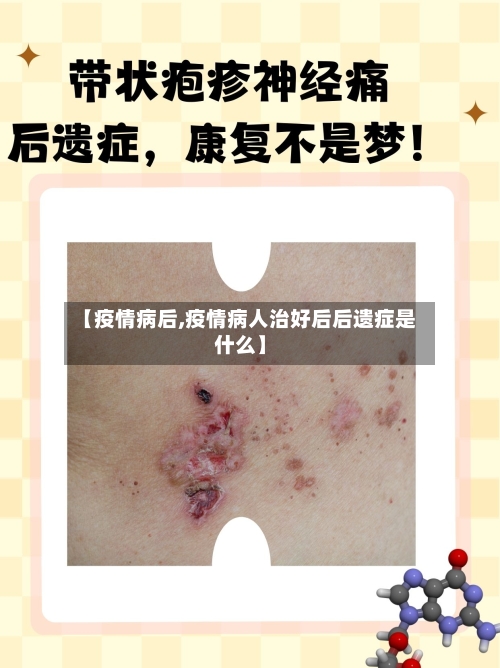 【疫情病后,疫情病人治好后后遗症是什么】-第2张图片